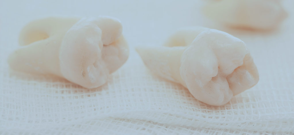 Wisdom Tooth Removal | Impacted Wisdom Teeth - Westminster, LA